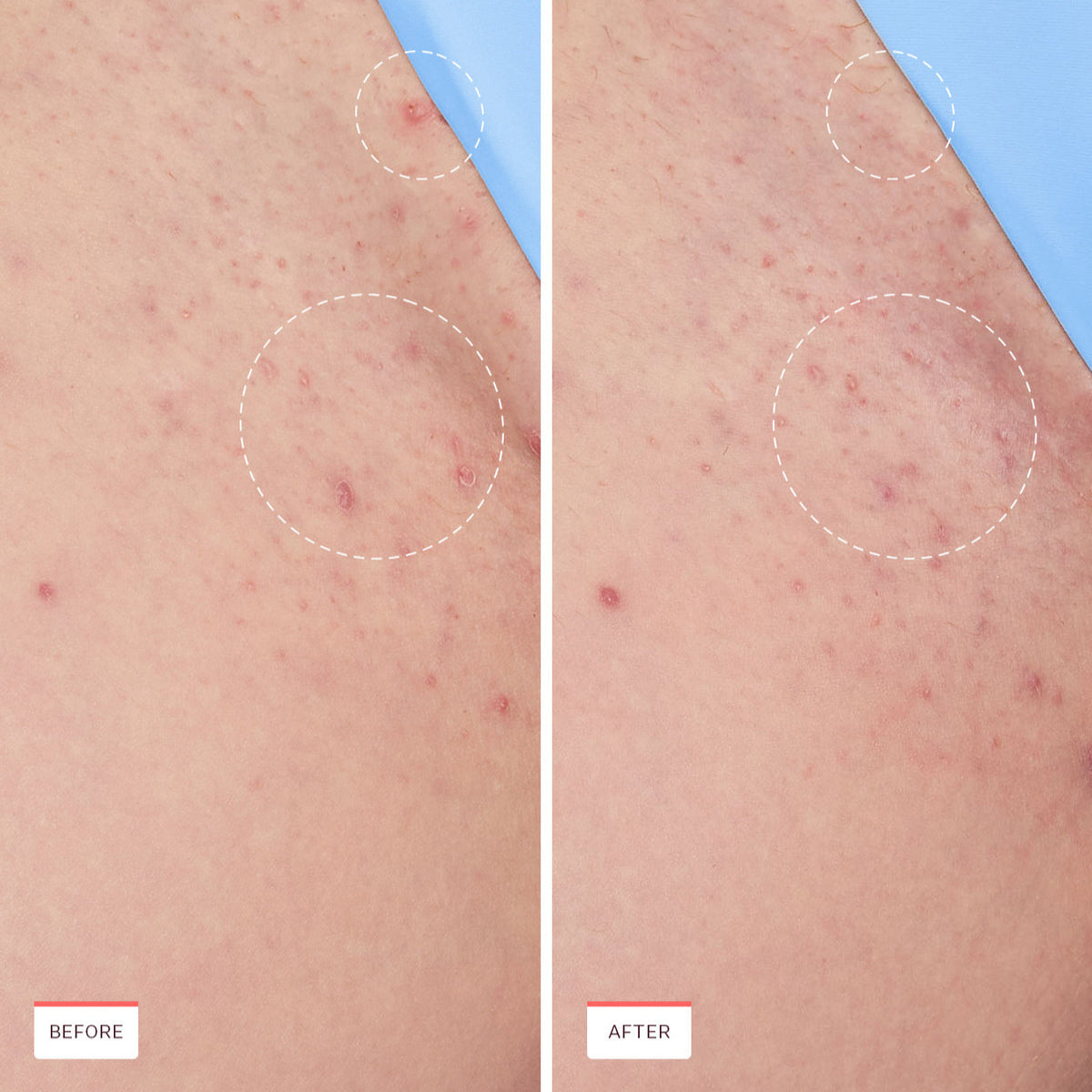 Smoothing Solution Ingrown Hair Treatment