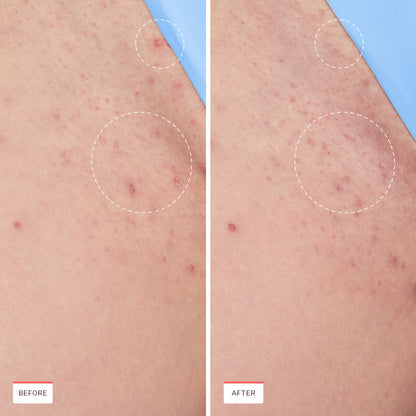 Smoothing Solution Ingrown Hair Treatment